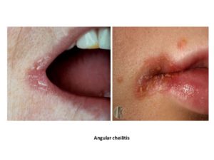 Does Angular Cheilitis Free Forever Work